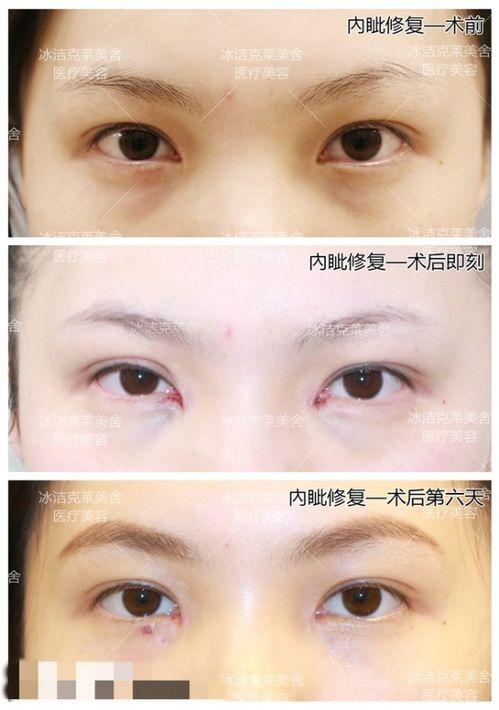 开眼角在线视频,在线视频带你直观了解